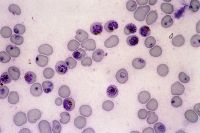 malaria-infected-cells
